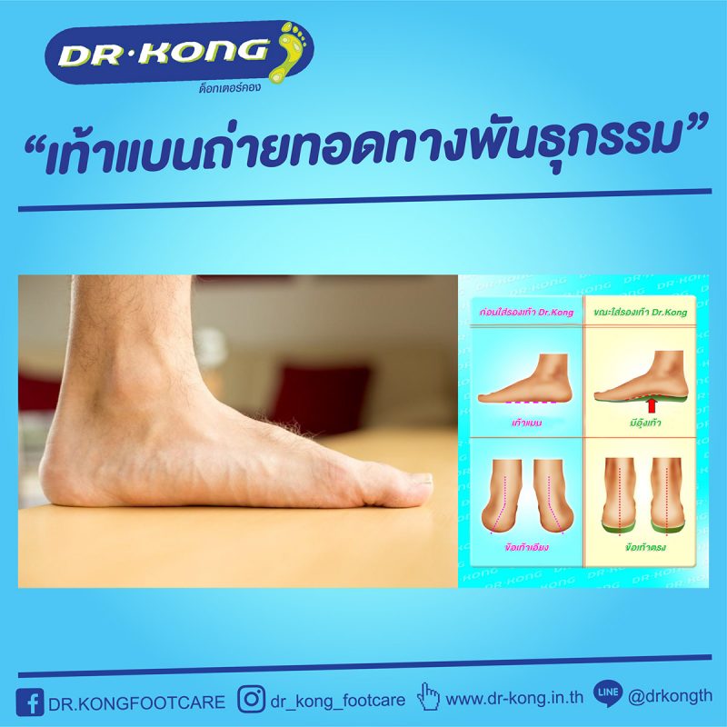 รองเท้าเพื่อสุขภาพ Dr.Kong สำหรับผู้ที่รักสุขภาพ หรือผู้ที่มีปัญหาเท้าแบน ปวดขา ปวดเข่า เพื่อสุขภาพเท้าที่ดีกว่า